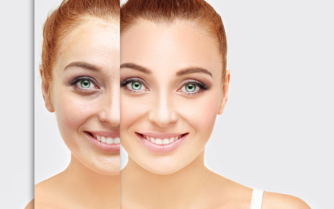 BOTOX vs DYSPORT vs XEOMIN – Jaký je mezi nimi rozdíl?